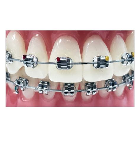 metal brackets ortho|stainless steel orthodontic braces.